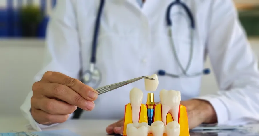How Dental Implant Trials Advance Patient Care