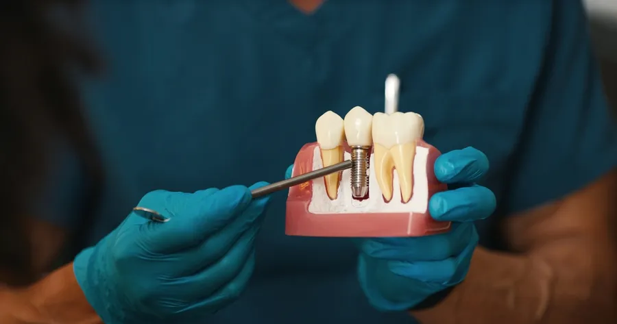 How Dental Implant Trials Advance Patient Care