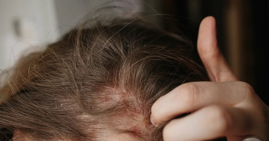 Scalp Psoriasis Medication: Effective Solutions for Relief and Comfort