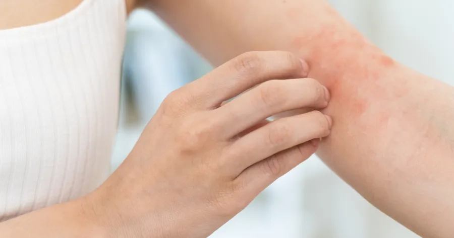 Atopic Dermatitis: Affordable, Effective, and Accessible Solutions