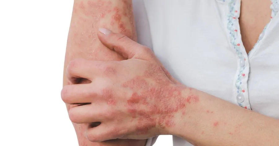 Eczema: Affordable Treatments for Healthier Skin