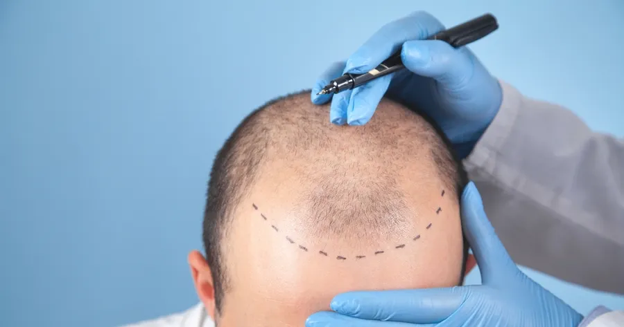 Considering a Hair Transplant? Here’s What to Expect