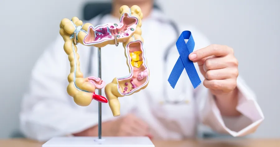 Colon Cancer Warning Signs