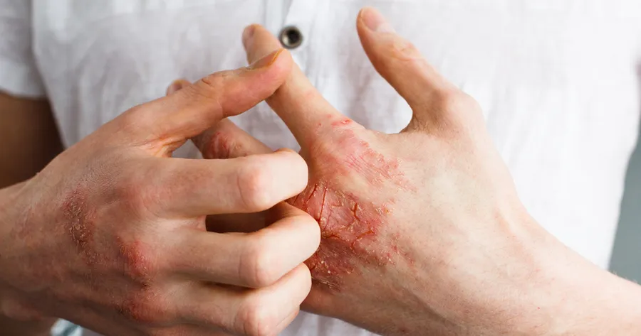 Everything You Need To Know About Eczema