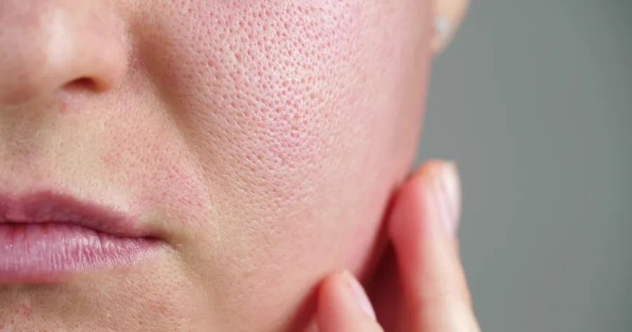 Oily Skin? Top Beauty Rituals to Reduce the Shine