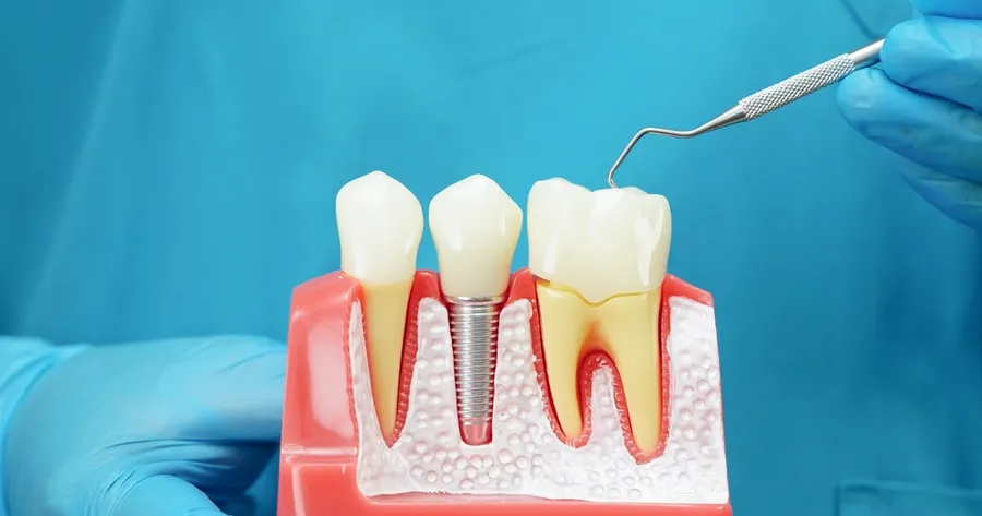 Affordable Dental Implants Through Trials