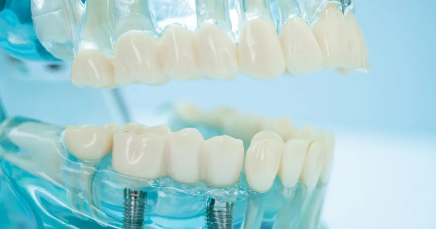 Dental Implants Can Be Affordable And May Be Fully Covered By Medicare Part C, Grants, Clinical Trials Or Select Insurance Plans.