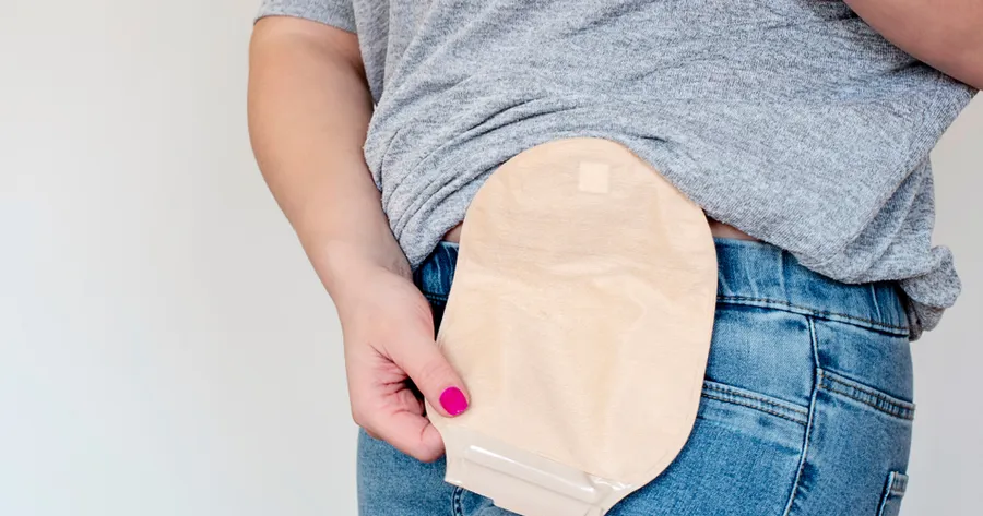 Worry Less, Live More — Modern Ostomy Pouches Designed for You
