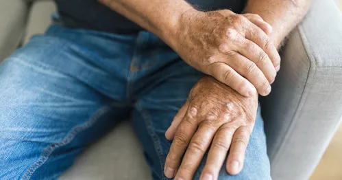 Managing Psoriatic Arthritis: Treatments and Solutions for a Better Quality of Life