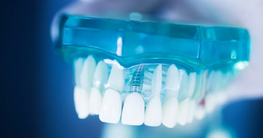 What to Know About Dental Implant Trials: A Participant’s Guide