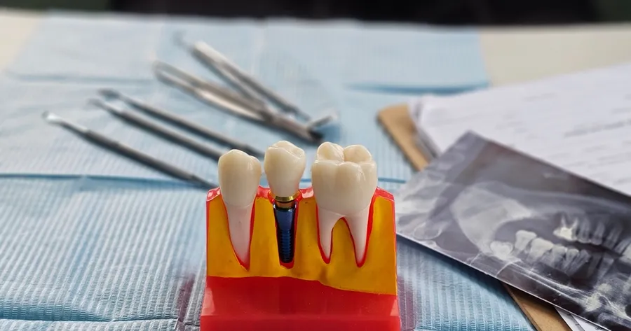 Explore the Benefits of Dental Implants Today