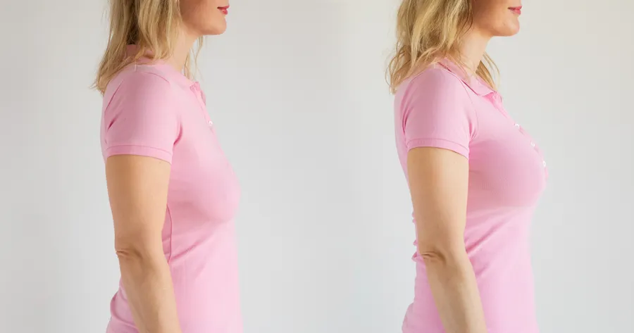 Breast Lift Trends in 2025: Natural Results, Smarter Planning