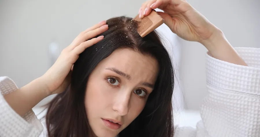 Best Psoriasis Shampoos for Scalp Relief in 2025