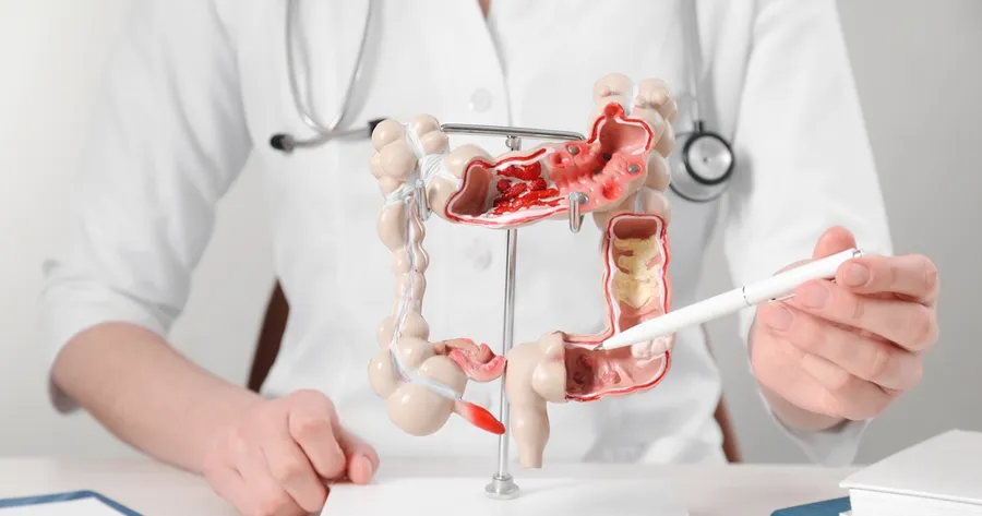 What Your Stool May Reveal About Colon Cancer