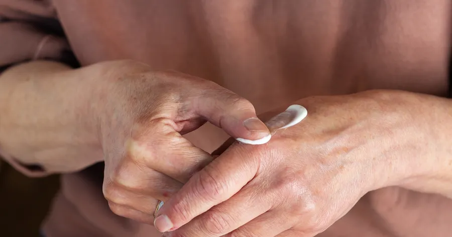What are the Best Eczema Creams?
